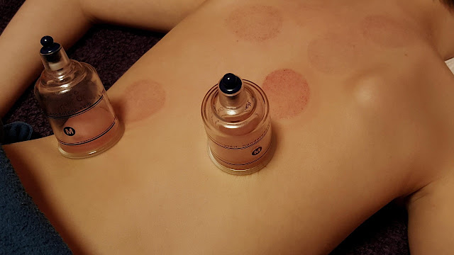 dry cupping therapy session-1